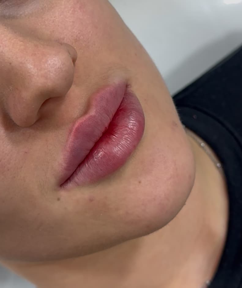 Lip filler treatment example one